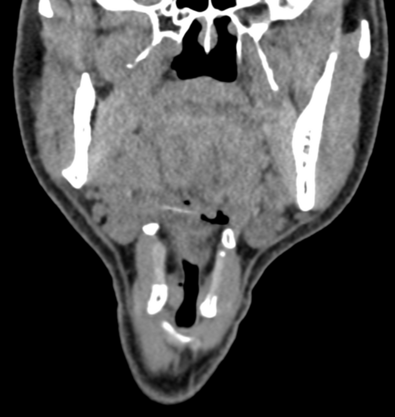 CT coronal